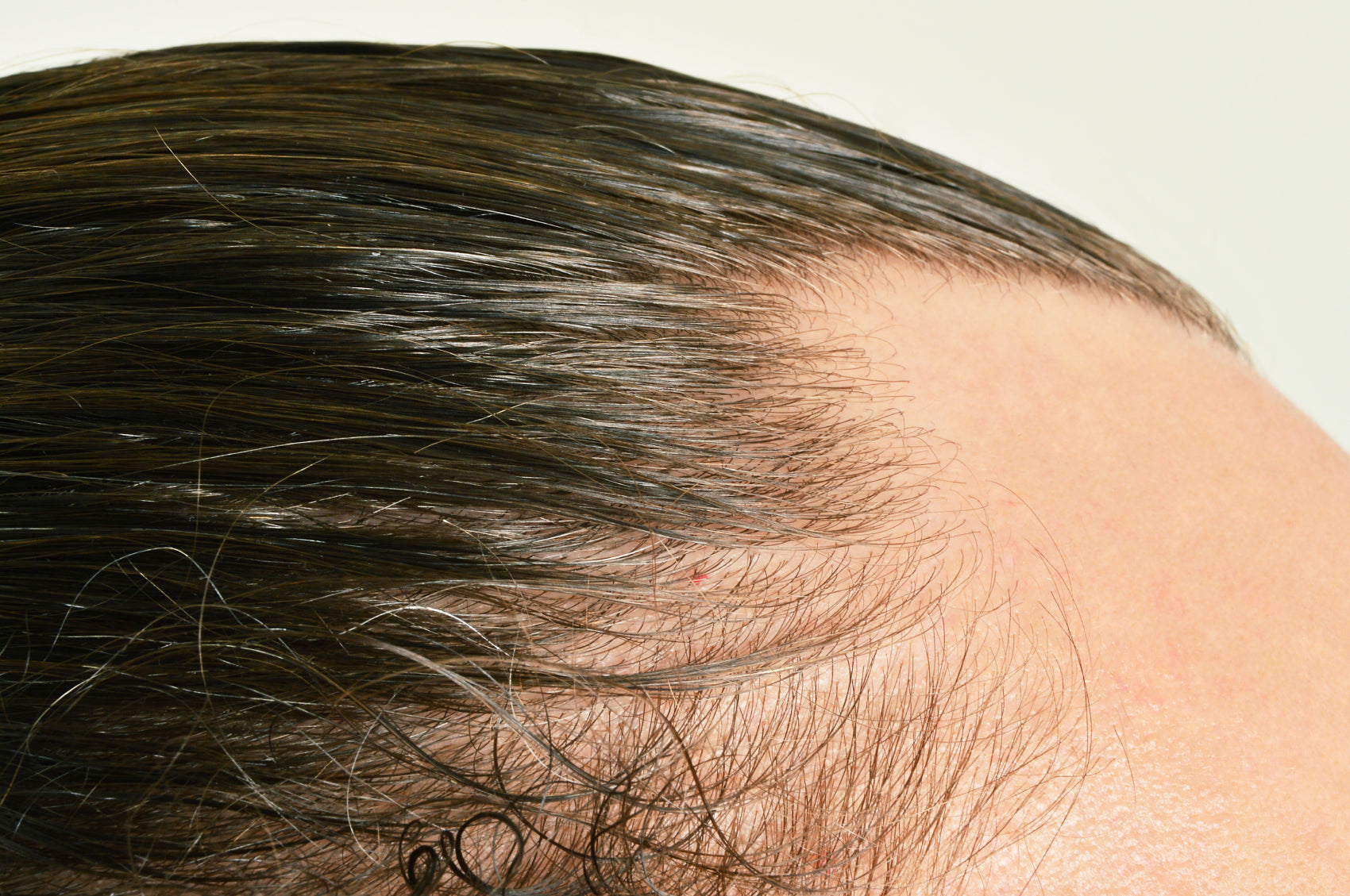 Woman examining a widening part line — female-pattern hair thinning and shedding