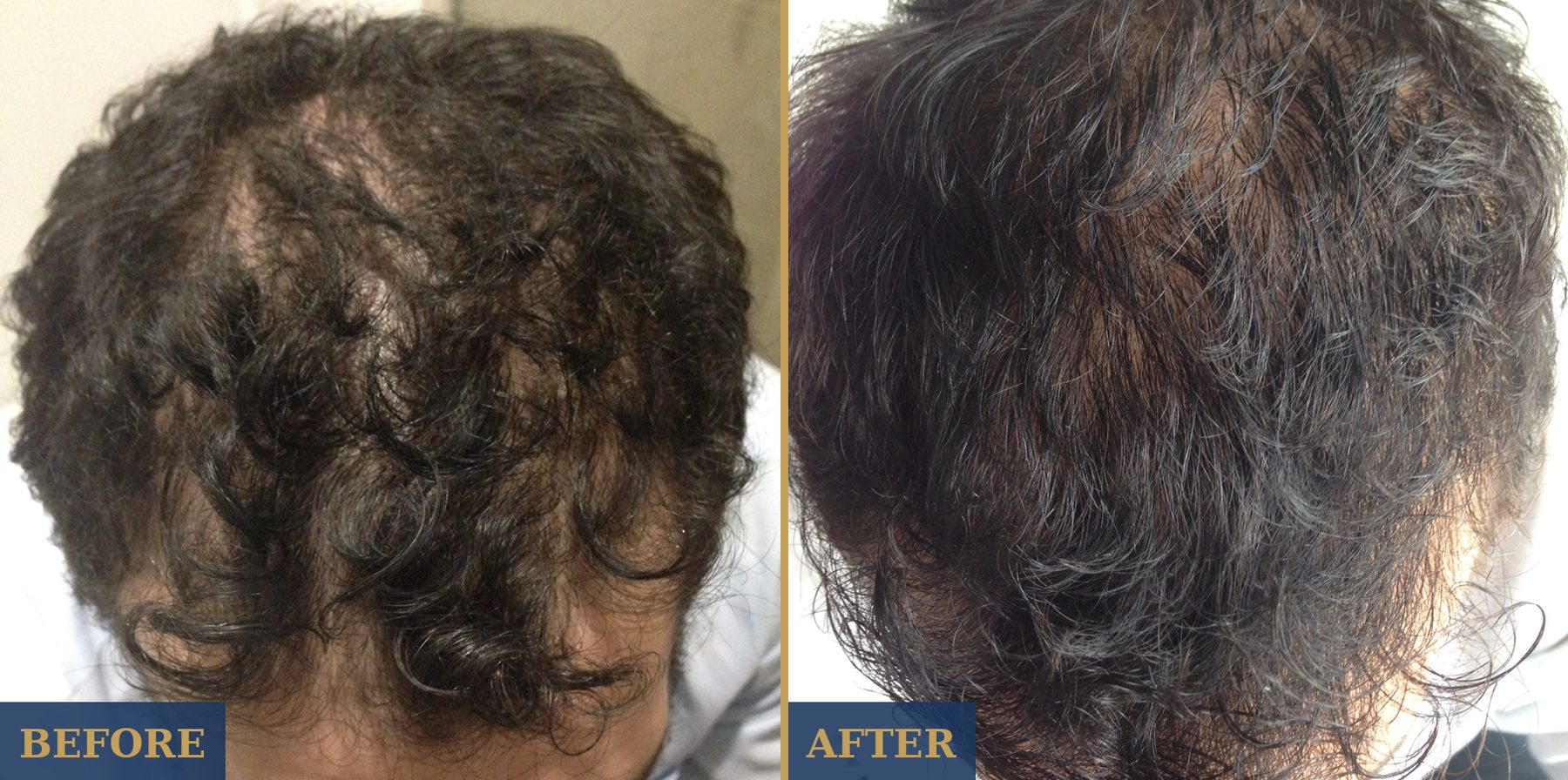 MD Hair before and after — visibly denser crown regrowth after consistent use. Individual results vary.