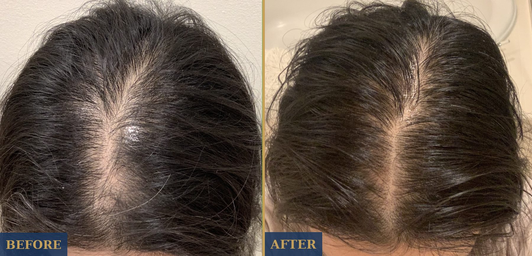 MD Hair before and after — a fuller, denser-looking part with less visible scalp after consistent use. Individual results vary.
