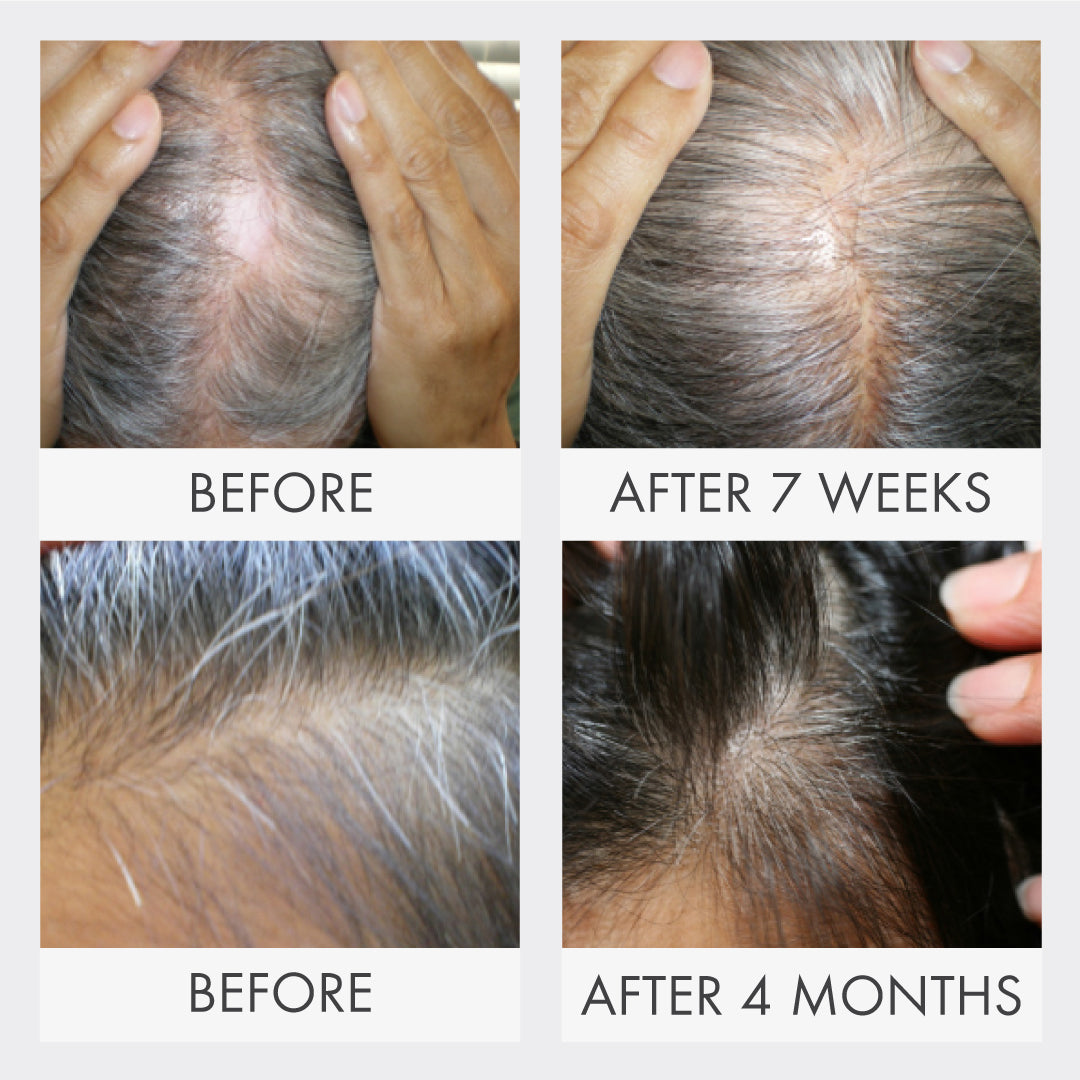 Before and after photo of an MD Follicle Energizer user with fuller-looking hair