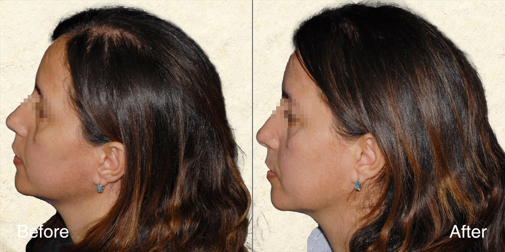 Before and after photo of a young man's hair looking fuller following consistent use of MD Follicle Energizer
