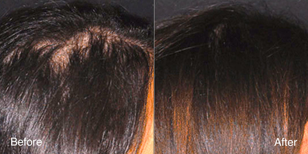 Before and after photo of thinning at the top of the scalp on a woman, looking fuller following consistent use of MD Follicle Energizer