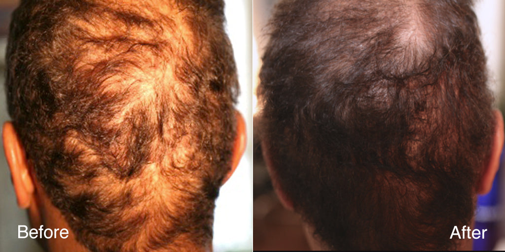 Before and after photo of a man at twelve weeks of MD Nutri Hair, MD Scalp Essential, and MD Follicle Energizer, showing thicker-looking hair