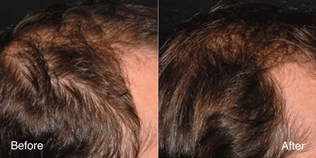 Before and after photo from a clinical assessment showing fuller-looking density at a man's part with MD Follicle Energizer