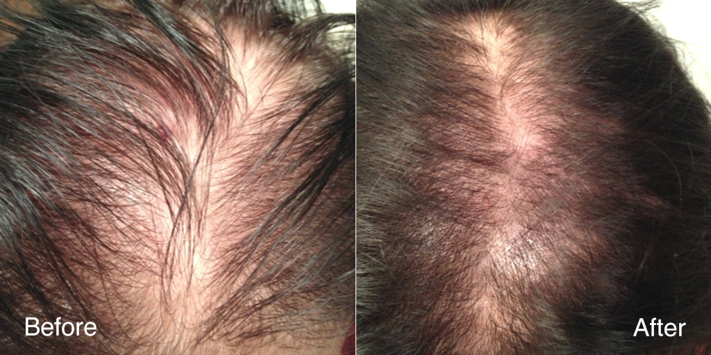Before and after photo of a woman's overall hair coverage looking fuller following consistent use of MD Follicle Energizer