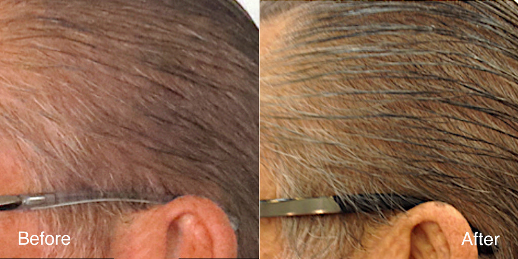 MD Color Restoration drug-free foam applied to gray roots at the hairline
