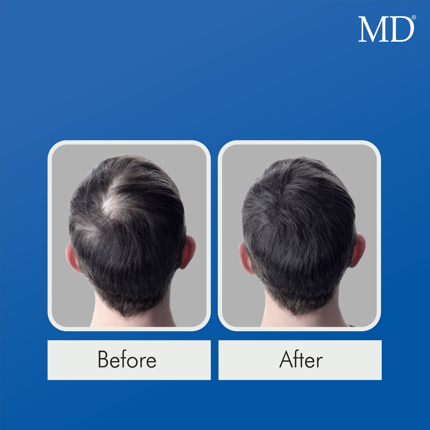 Before and after photo of a thinning area at the crown looking fuller following consistent use of MD Follicle Energizer
