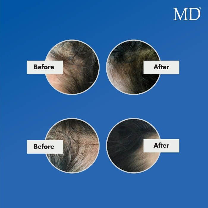 Before and after photo of a woman's hairline and temples looking fuller following consistent use of MD Nutri Hair